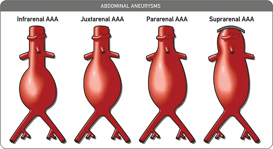 Abdominal aortic aneurysms can be classified as infrarenal, juxtarenal, pararenal or suprarenal as depicted in the illustration.