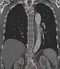 Several congenital block vertebrae in the transition from the thoracic to the lumbar spine and hemivertebrae.