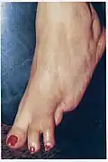 Healed