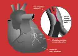 Heart attack