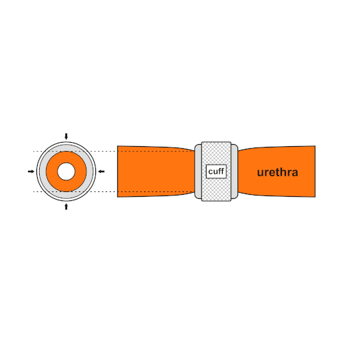 An animated GIF showing how the periurethral cuff of the AUS constricts the urethra