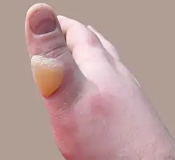 Second-degree burn of the thumb