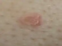 Chronic folliculitis surrounding central sebaceous hyperplasia, right mid-chest