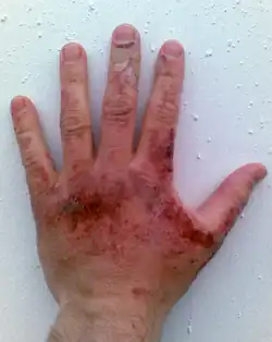 Red erosions, some with crusting, all on the back of an adult hand