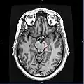 Horizontal MRI (T1 weighted) slice with highlighting indicating location of the substantia nigra.