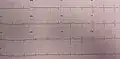 EKG/ECG in someone with Wellens' syndrome when having chest pain